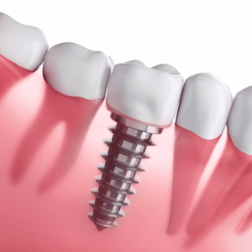 Implant Dentistry Marengo IL