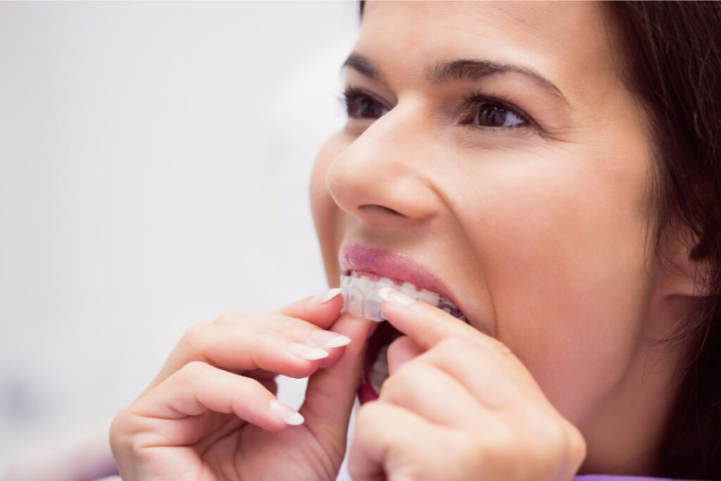 Protecting enamel from uneven wear with Invisalign