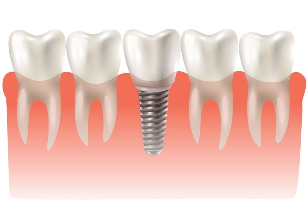 Dental implant illustration showing titanium screw placement between natural teeth and gums.