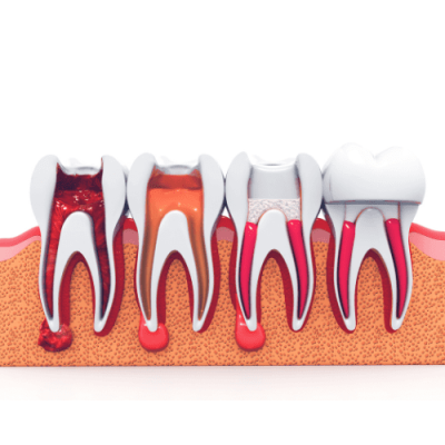 Illustration showing four teeth with progressive stages of tooth decay and dental treatment options.