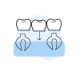 Dental Bridges | Family Dentistry Marengo IL